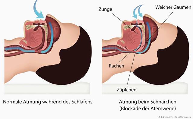Blockade der Atemwege beim Schnarchen