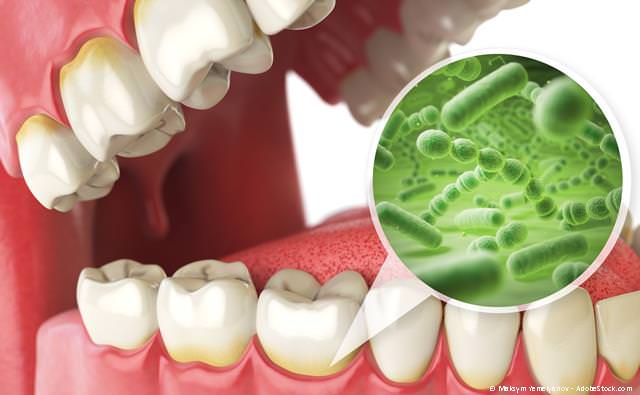 Entzündungen im Mund durch schädliche Bakterien